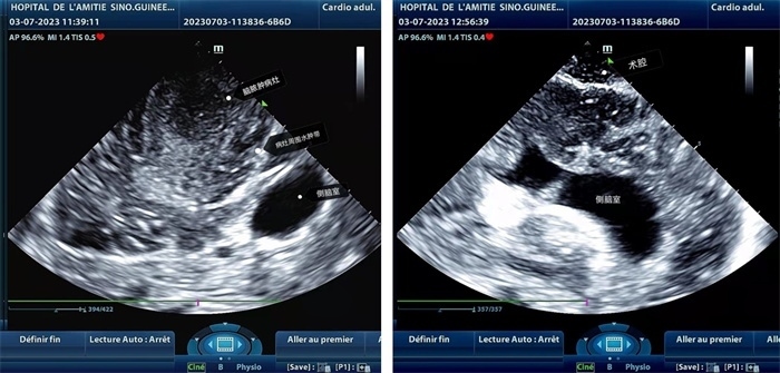 左圖顯示術(shù)中超聲見(jiàn)囊實(shí)性病變，大小約為4x4x3cm，病灶周圍腦組織水腫明顯；右圖為病灶切除后，術(shù)中超聲示術(shù)腔無(wú)病變殘留