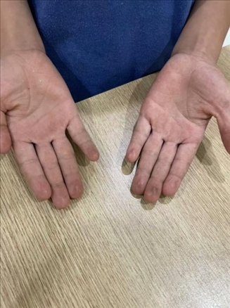 9歲小學(xué)生長期拍煙卡，手部粗糙長繭。受訪者供圖