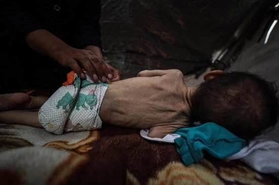 這是5月28日在加沙城西部一處臨時安置點拍攝的一名營養(yǎng)不良的嬰兒。新華社發(fā)（馬哈茂德·扎基攝）